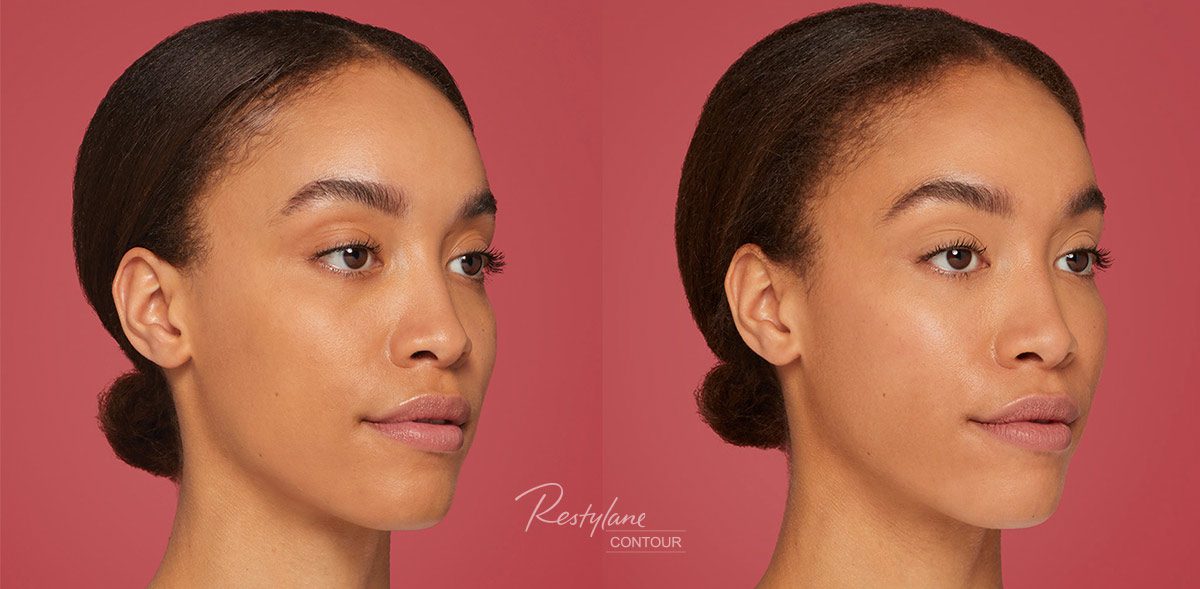 New Filler Alert: Restylane Contour Is Here